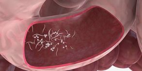 D'Benotzung vun Tripleten fir Parasiten ze läschen