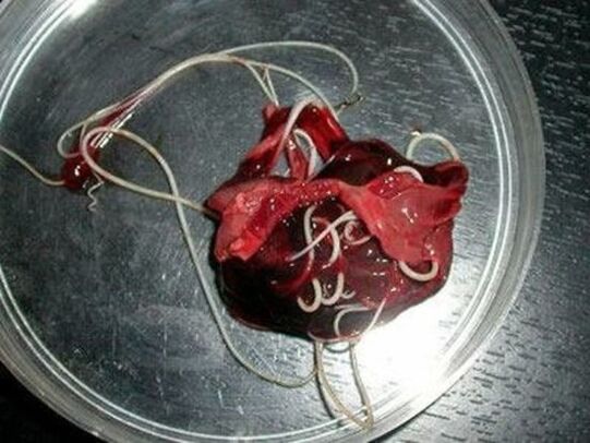 Würmer aus dem mënschleche Kierper